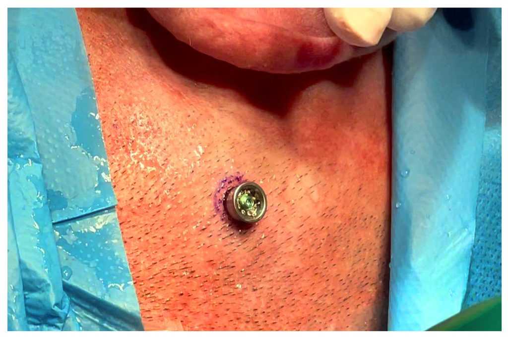 Sivas'ta İşitme Kaybına Çözüm: Kemik İçi İşitme Cihazı Başarıyla Uygulandı! 3 1 | Gündem Sivas™ Haber