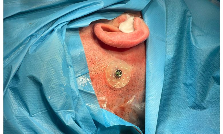 Sivas'ta İşitme Kaybına Çözüm: Kemik İçi İşitme Cihazı Başarıyla Uygulandı! 4 | Gündem Sivas™ Haber