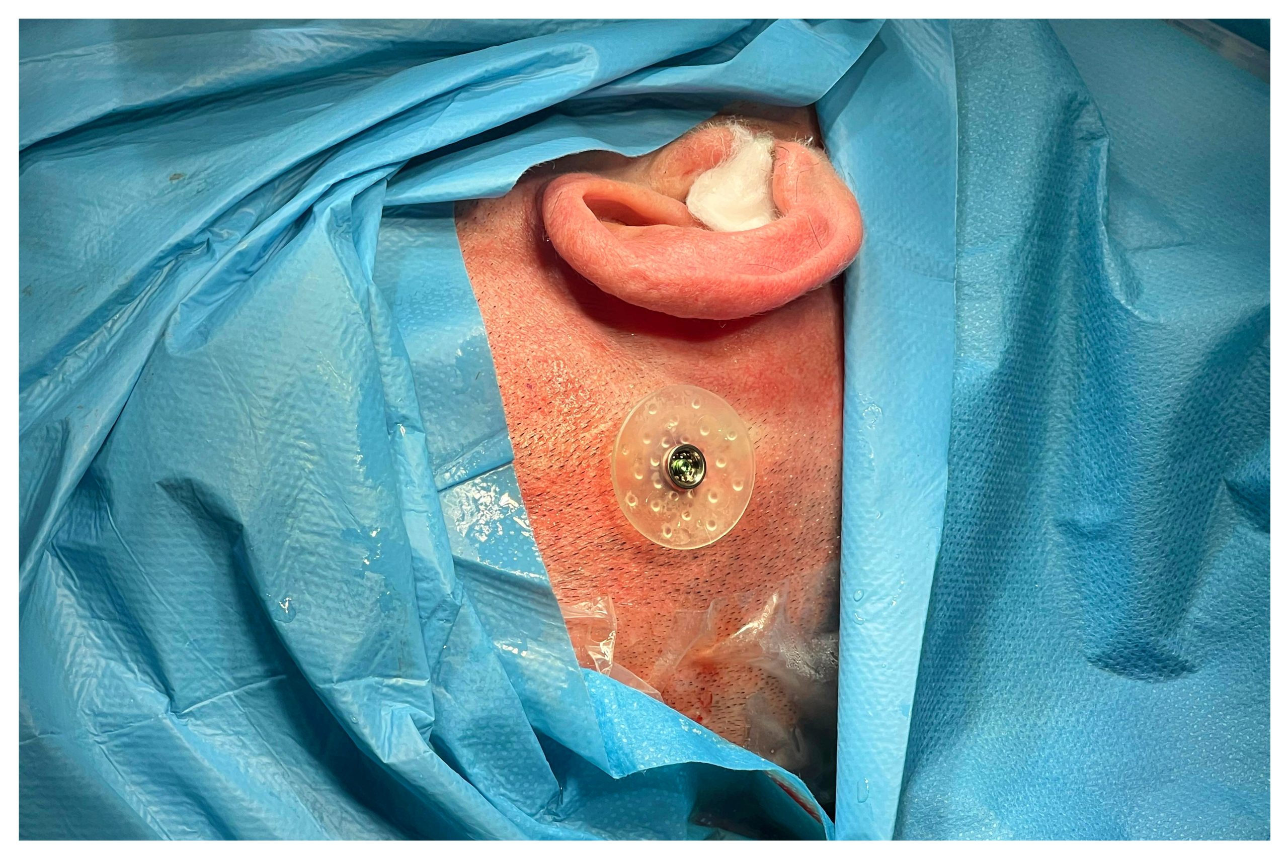 Sivas'ta İşitme Kaybına Çözüm: Kemik İçi İşitme Cihazı Başarıyla Uygulandı!