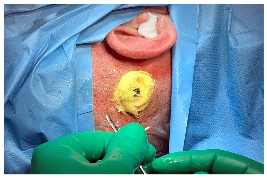Sivas'ta İşitme Kaybına Çözüm: Kemik İçi İşitme Cihazı Başarıyla Uygulandı! 5 | Gündem Sivas™ Haber