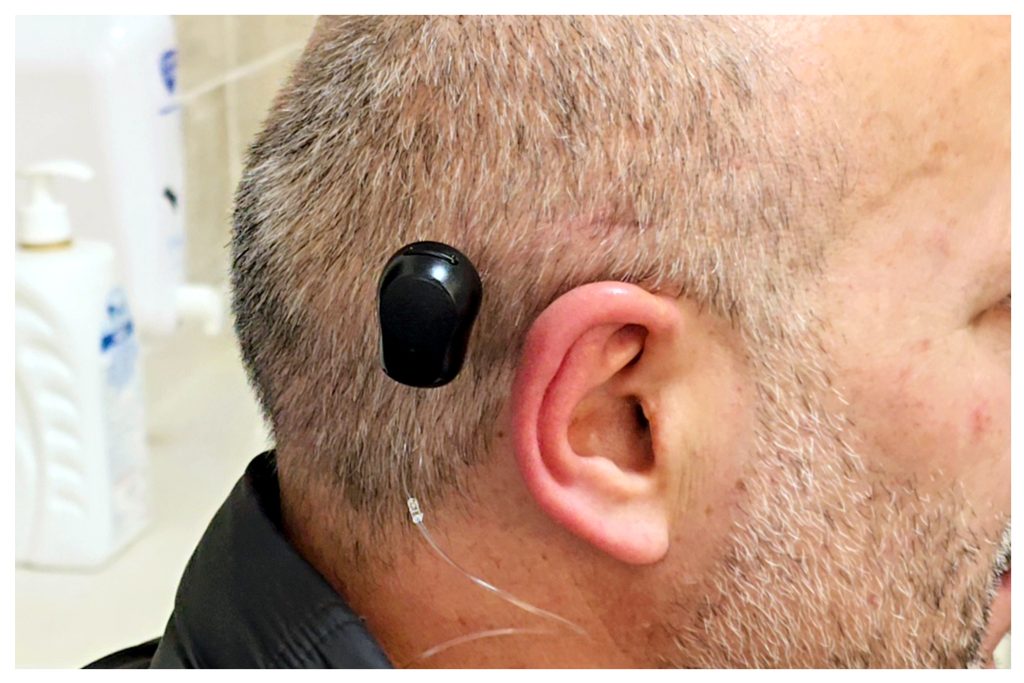 Sivas'ta İşitme Kaybına Çözüm: Kemik İçi İşitme Cihazı Başarıyla Uygulandı! 6 | Gündem Sivas™ Haber