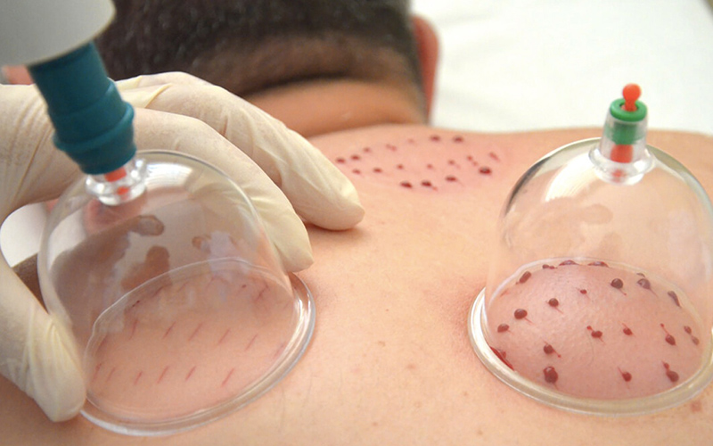 Türkiye’de Geleneksel Tedaviler Resmi Sağlık Sistemine Entegre Edildi Türkiye’de Geleneksel Tedaviler Resmi Sağlık Sistemine Entegre Edildi