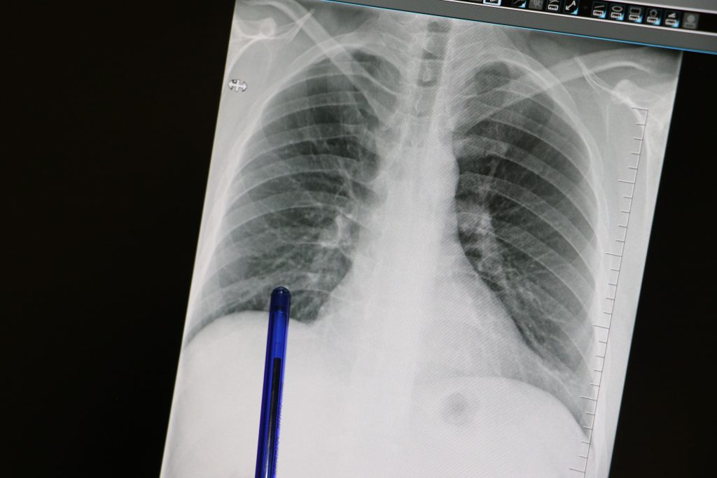 Öksürük ve Balgam Basit Bir Belirti Olmayabilir! Erken Tanı Hayat Kurtarır