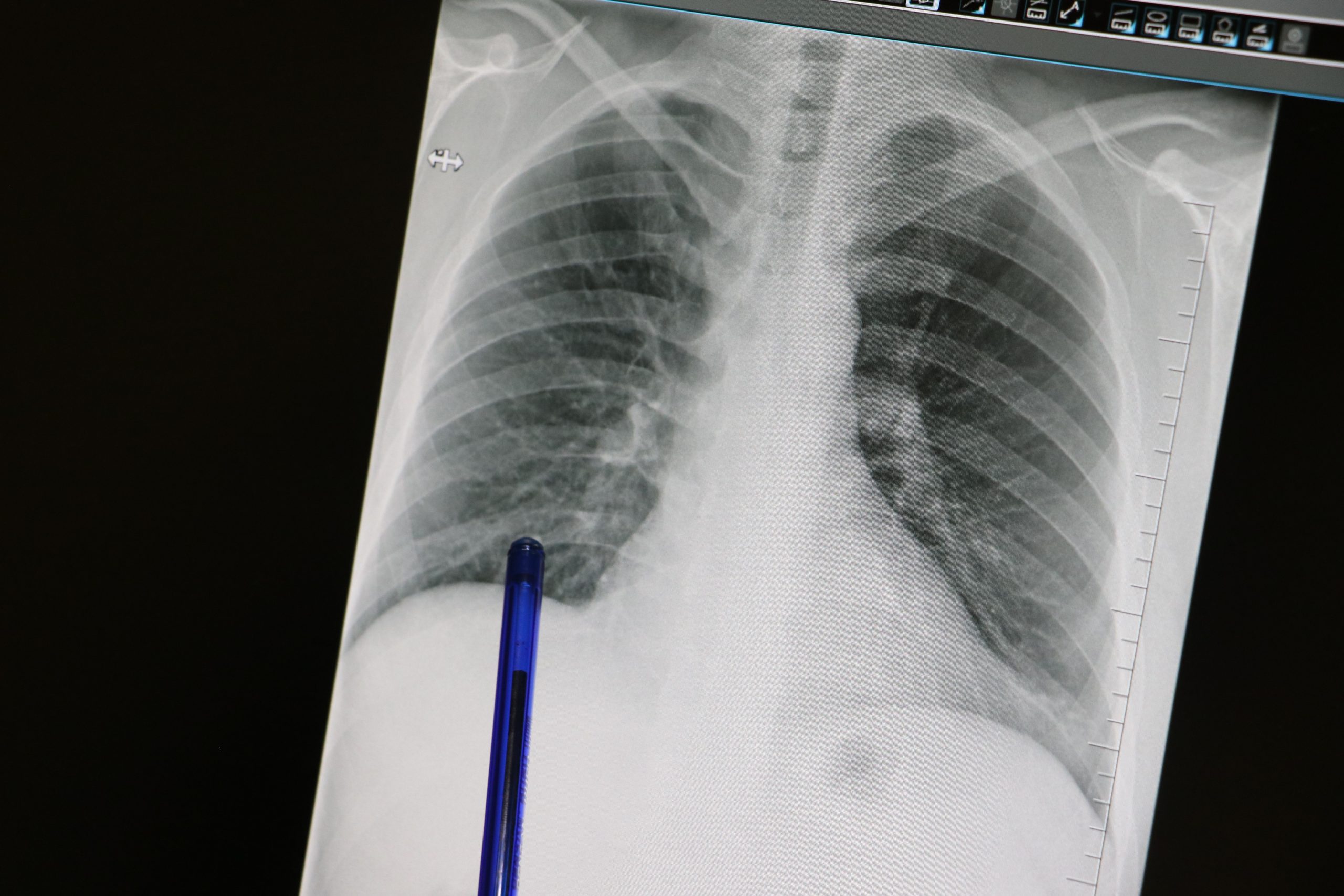 Öksürük ve Balgam Basit Bir Belirti Olmayabilir! Erken Tanı Hayat Kurtarır