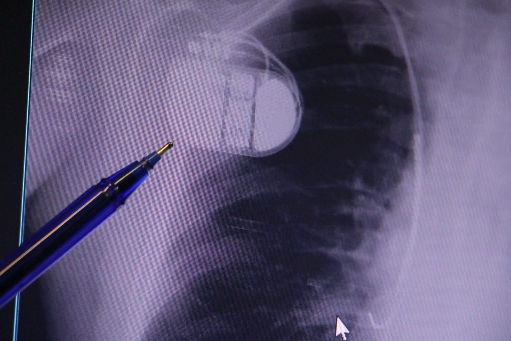 Kalp Pili Kullanıcılarına Soğuk Hava Uyarısı: Ani Ölüm Riskine Dikkat!