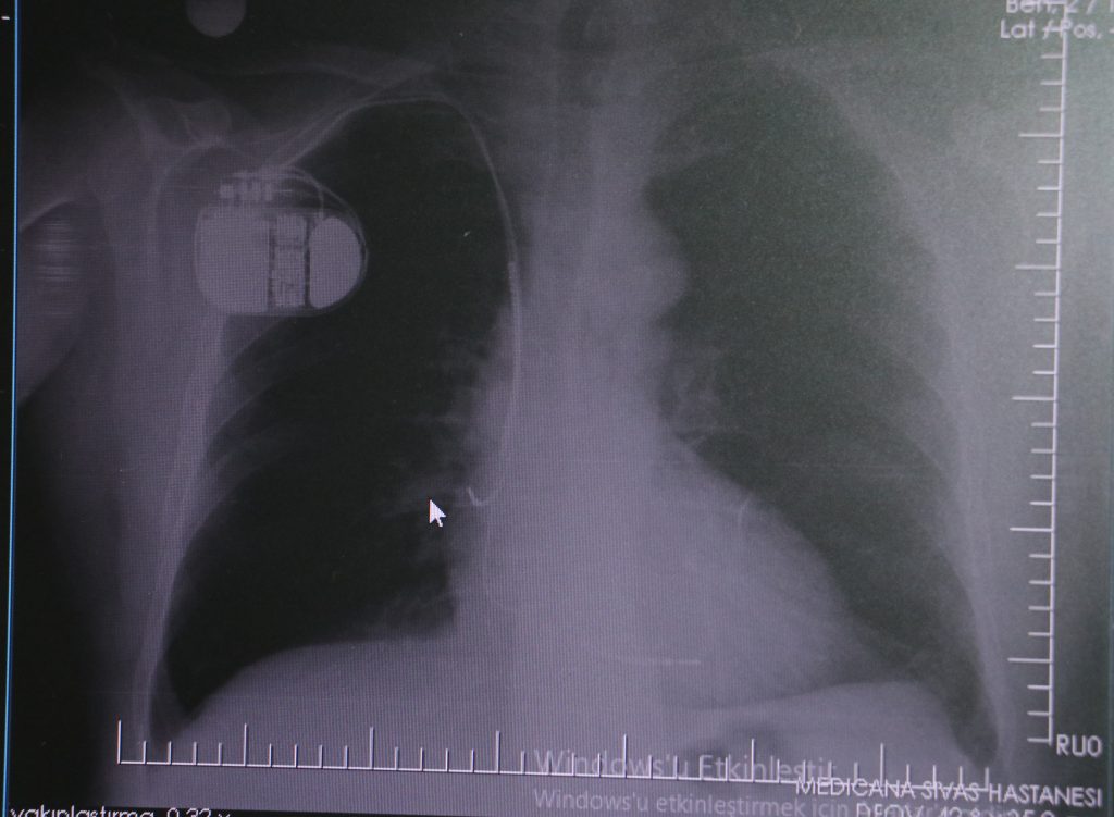 Kalp Pili Kullanıcılarına Soğuk Hava Uyarısı: Ani Ölüm Riskine Dikkat! AW576546 04 | Gündem Sivas™ Haber