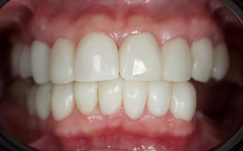 Depremden İlham Alan Türk Profesörden Diş Tedavisinde Devrim: İmplantsız İnci Gibi Gülüşler