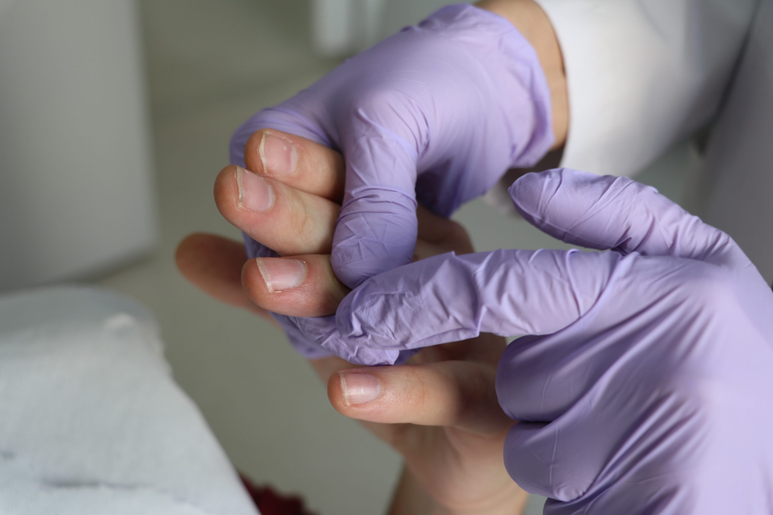 Soğuk Havalar Kapıda: Uzman Uyardı, Donma Vakalarında Gecikme Uzuv Kaybına Götürebilir