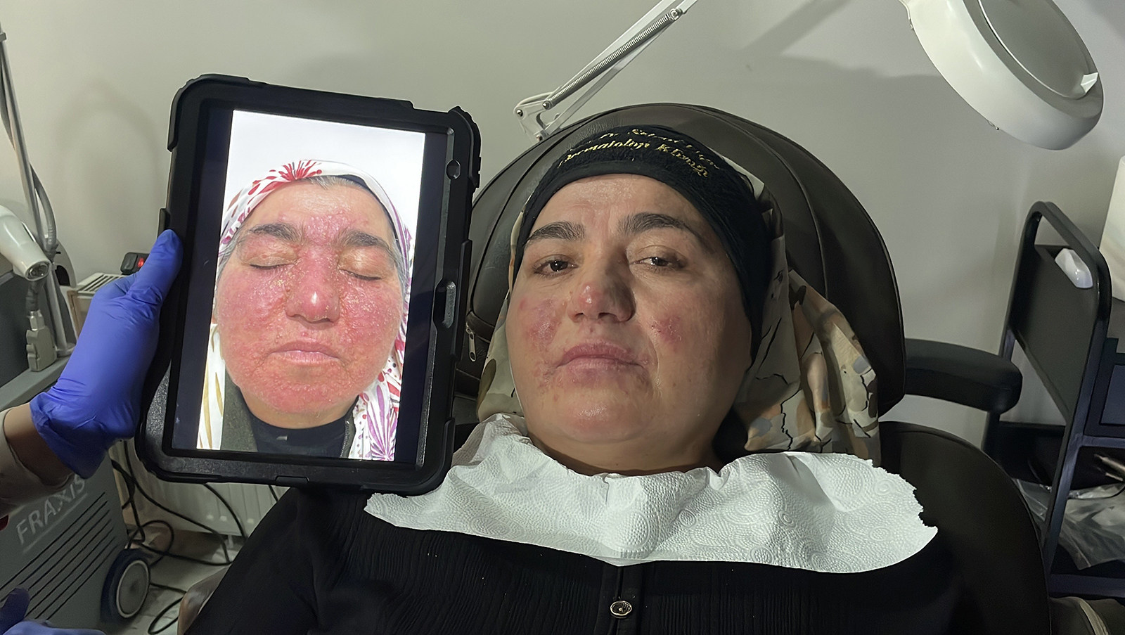 Gül Hastalığı Nedeniyle 20 Yıl Evden Çıkamadı: Sivas’ta Başlayan Tedaviyle Hayata Yeniden “Merhaba” Dedi