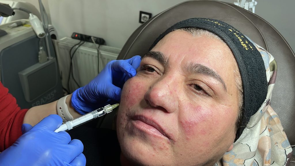 Gül Hastalığı Nedeniyle 20 Yıl Evden Çıkamadı: Sivas’ta Başlayan Tedaviyle Hayata Yeniden “Merhaba” Dedi AW646314 05 | Gündem Sivas™ Haber