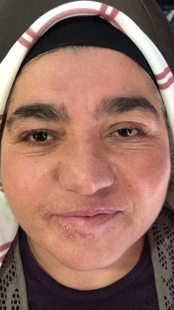 Gül Hastalığı Nedeniyle 20 Yıl Evden Çıkamadı: Sivas’ta Başlayan Tedaviyle Hayata Yeniden “Merhaba” Dedi AW646314 07 | Gündem Sivas™ Haber